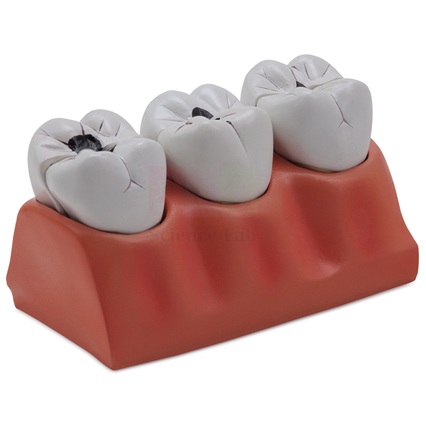 Dental Caries Model